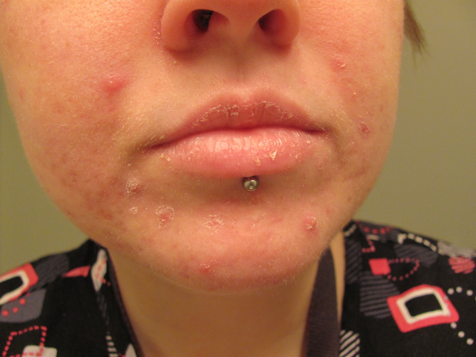 Accutane Dry Lips ― Choose a product